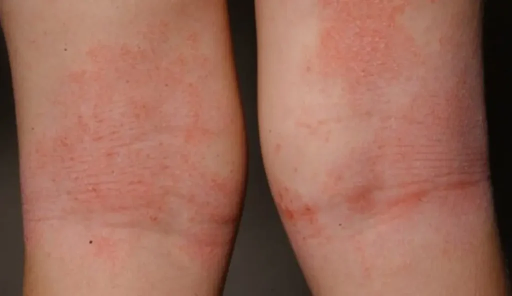 Eczema treatment in ayurveda