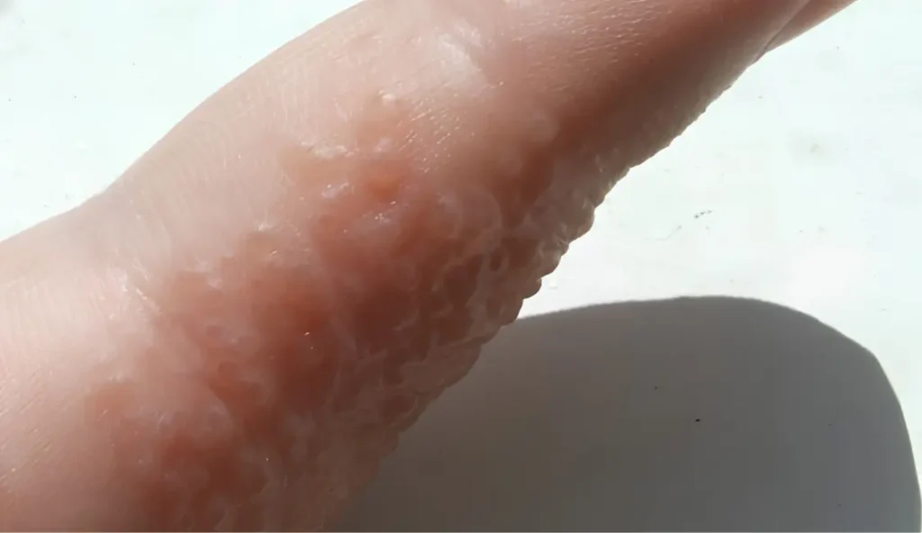 Eczema treatment in ayurveda