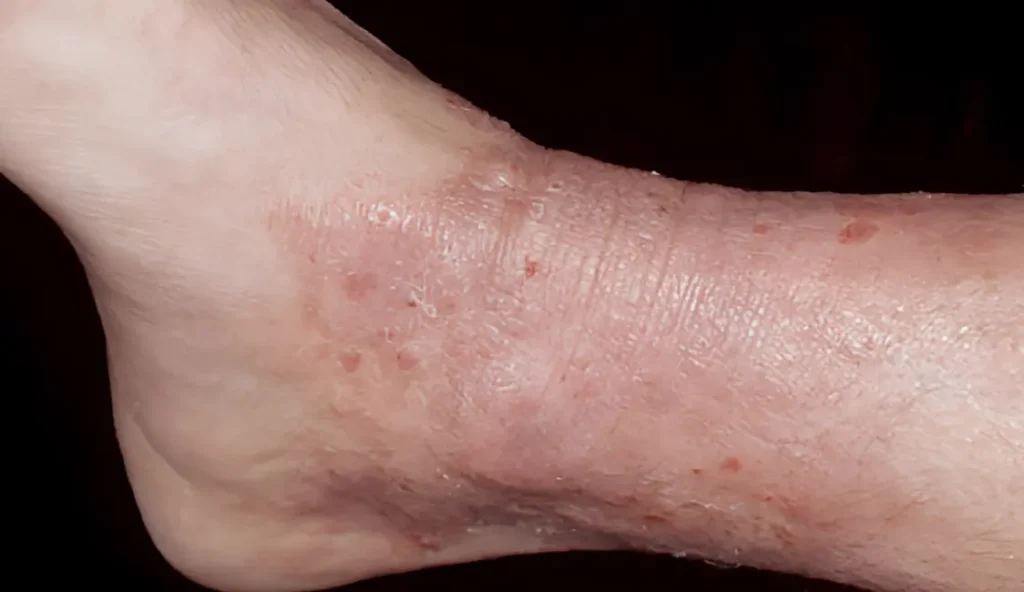 Eczema treatment in ayurveda