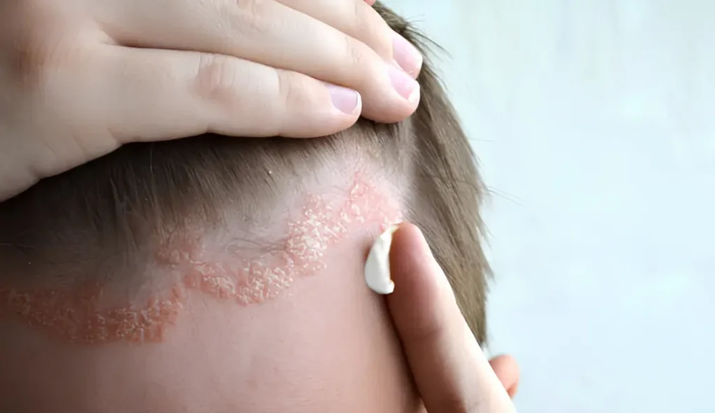 Eczema treatment in ayurveda