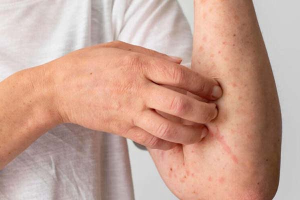 Navigating the Challenges of Eczema: Understanding Treatment Options in Ayurveda