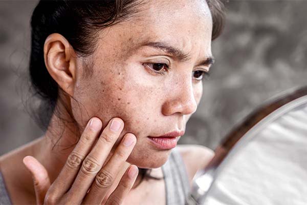 facial-pigmentation