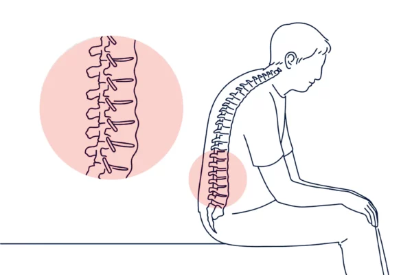Ayurveda-Management-of-Ankylosing-Spondylitis