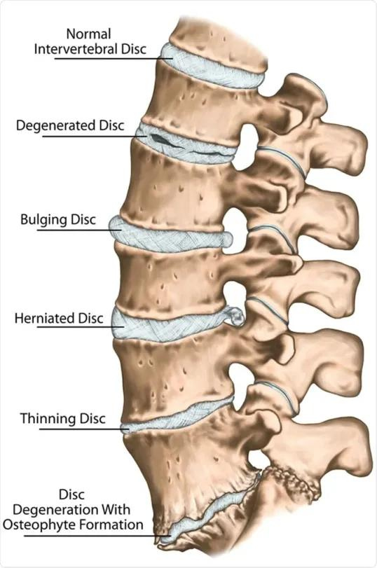 The image shows the difference between normal human intervertebral disc, degenerated disc, building disc, herniated disc, thinning disc and disc degeneration with osteophyte formation