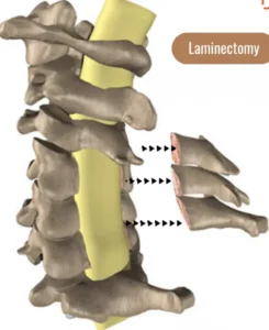 Ayurvedic Management of cervical spondylosis
