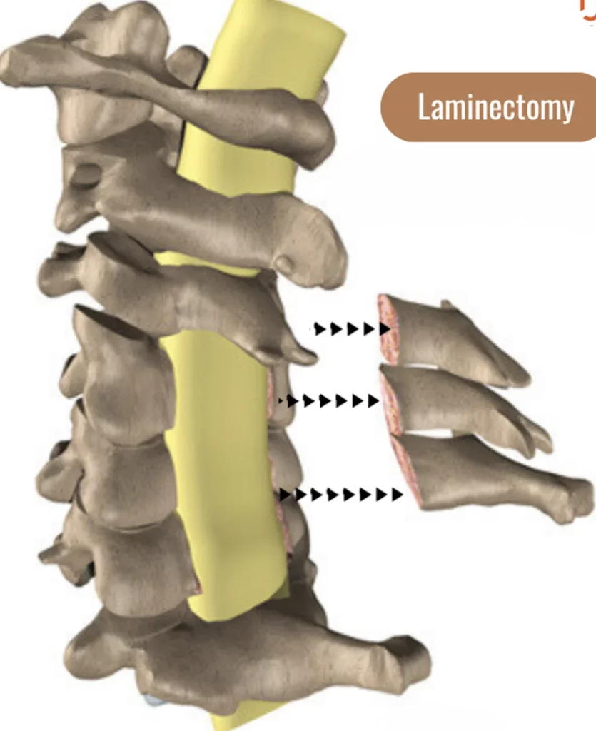 The image shows how the human spine looks after Laminectomy surgery