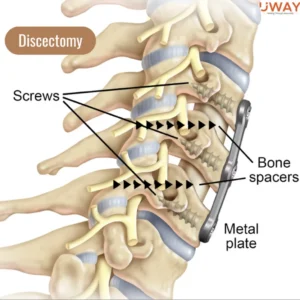Ayurvedic Management of cervical spondylosis
