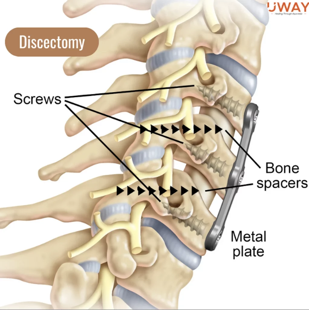 Image shows how's the human spine after Discectomy surgery for cervical spondylosis 