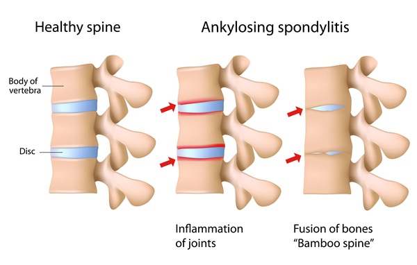Ayurvedic Management of Ankylosing Spondylitis
