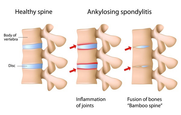 The image shows a normal human spine and degeneration due to Ankylosing spondylitis. One can notice the inflammation of joins in the spine and Fusion of bones, also known as Bamboo spine 