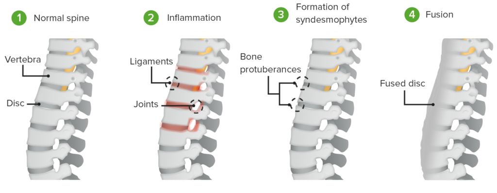 Ayurvedic Management of Ankylosing Spondylitis