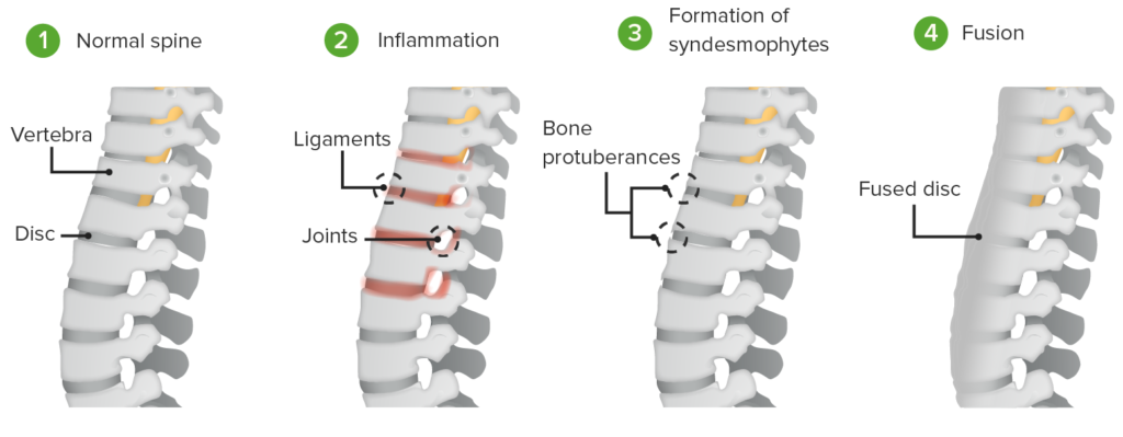 Ankylosing spondylitis (AS) is a progressive condition that primarily affects the spine and sacroiliac joints. The progression of AS can vary from person to person, but it typically occurs in several stages, each with its own characteristics and challenges. It's important to note that not everyone with AS will experience all of these stages, and the severity and timeline can differ. Here are the general stages of ankylosing spondylitis: