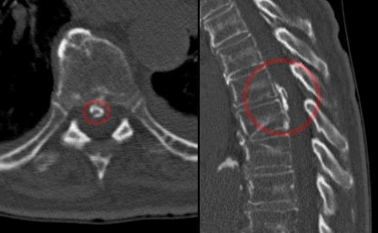 Ayurvedic Management of Ankylosing Spondylitis