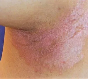 ayurvedic treatment for psoriasis , guttate psoriasis , Inverse Psoriasis