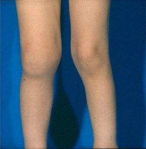 Ayurveda treatment for Arthritis 5 Ayurveda treatment for rheumatoid arthritis, Juvenile idiopathic arthritis