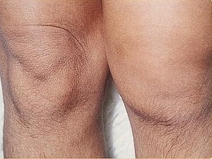 Ayurveda treatment for Arthritis 7 Ayurveda treatment for rheumatoid arthritis, Reactive arthritis