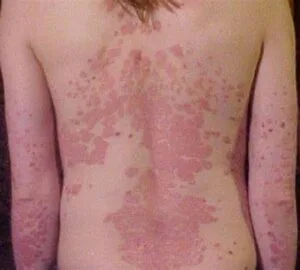 ayurvedic treatment for psoriasis , nail psoriasis , pustular psoriasis ,erythroderma-psoriasis