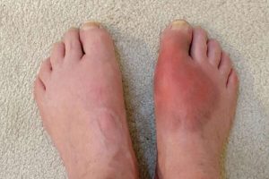 Ayurveda treatment for Arthritis 4 Ayurveda treatment for rheumatoid arthritis, Gout