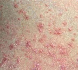 ayurvedic treatment for psoriasis , guttate psoriasis