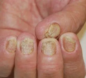ayurvedic treatment for psoriasis , nail psoriasis