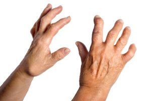 Ayurveda treatment for Arthritis 1 Ayurveda treatment for rheumatoid arthritis, osteoarthritis