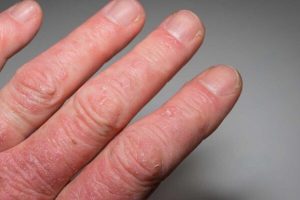 Ayurveda treatment for Arthritis 6 Ayurveda treatment for rheumatoid arthritis, Psoriatic arthritis