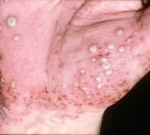 ayurvedic treatment for psoriasis , nail psoriasis , pustular psoriasis