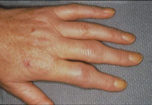 Ayurveda treatment for Arthritis 2 Ayurveda treatment for rheumatoid arthritis