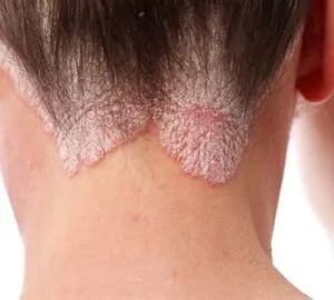 ayurvedic treatment for psoriasis , nail psoriasis , pustular psoriasis ,erythroderma psoriasis, scalp psoriasis