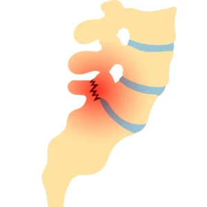 Integrated Medicine for Musculoskeletal Disorders, spondylosis