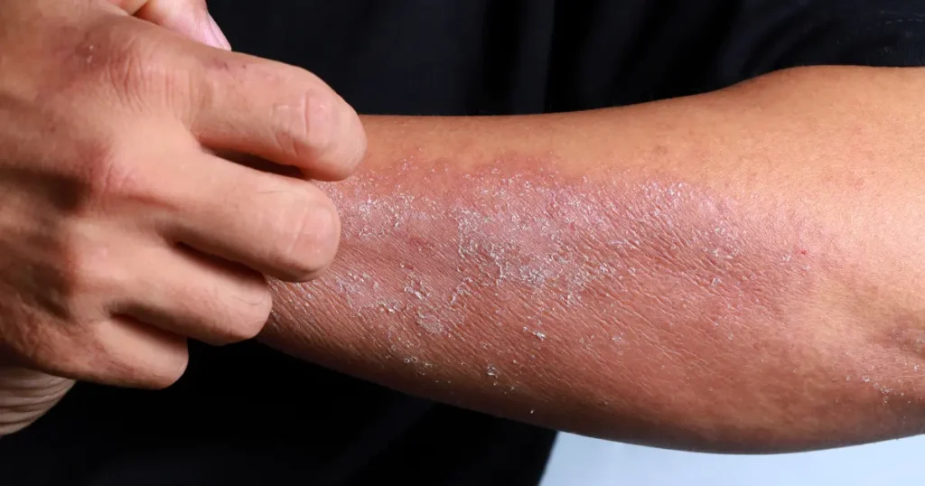 Comprehensive Ayurveda Treatment for Allergies at UWAY 3 Ayurveda Treatment for Allergies