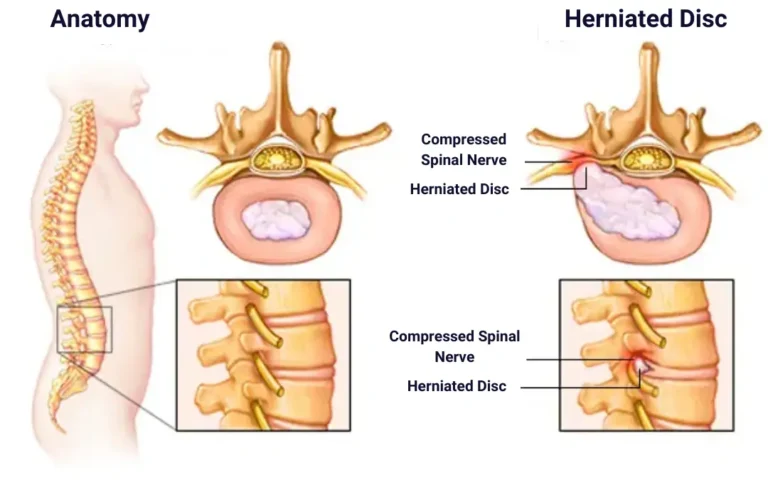 symptoms of herniated disc , herniated disc