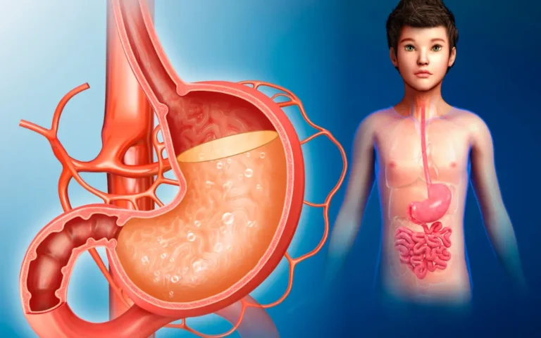 What are the symptoms of acid reflux or hyperacidity? Ayurvedic treatment for hyperacidity