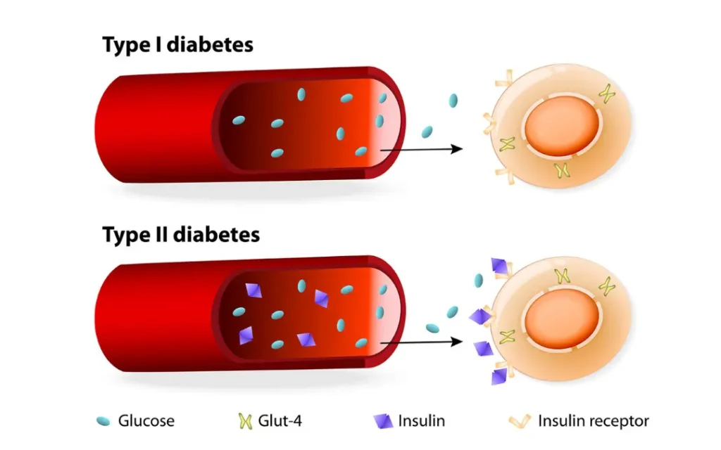 managing diabetes Diabetes Ayurvedic Treatment