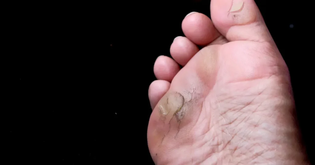 Ayurveda Treatment for Diabetes, types of diabetes, signs and symptoms of diabetes