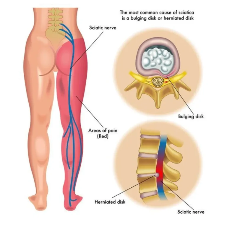ayurveda treatment for sciatica, sciatica symptoms