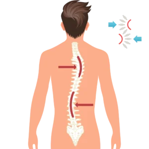 Integrated Medicine for Scoliosis