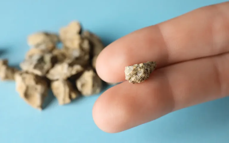 Managing Kidney Stones