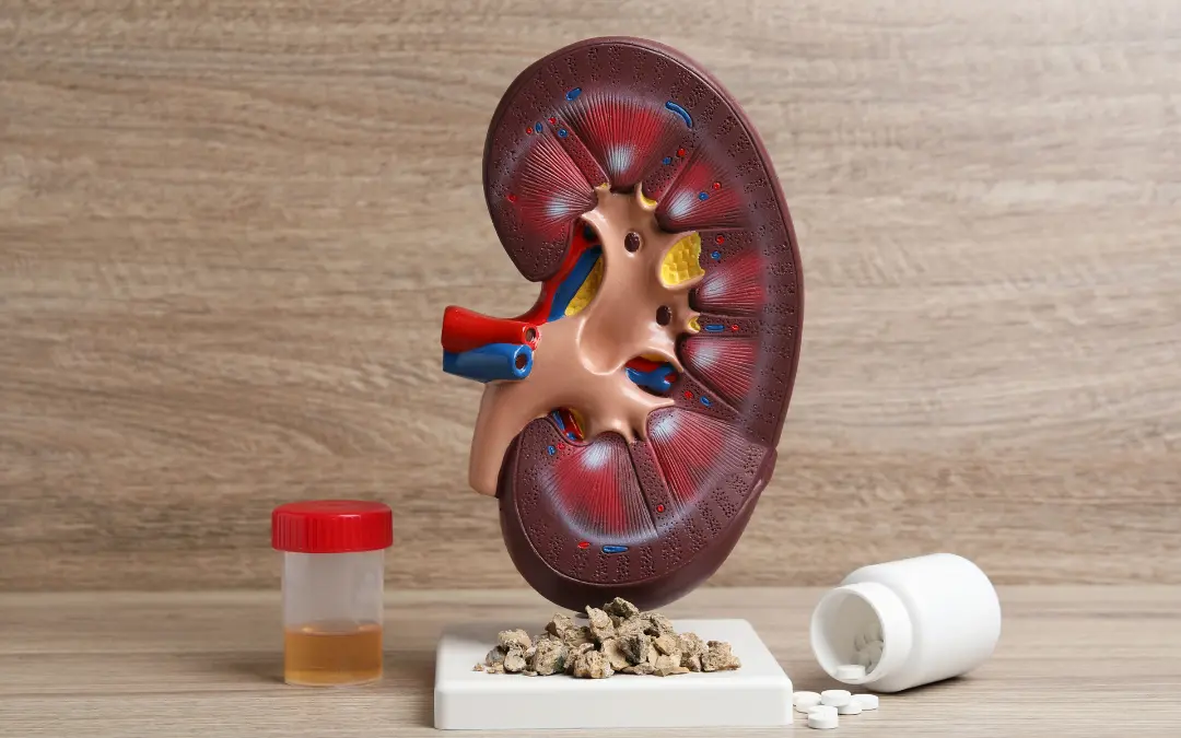 Managing Kidney Stones: