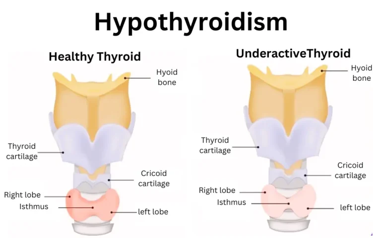 Ayurveda treatment for thyroid