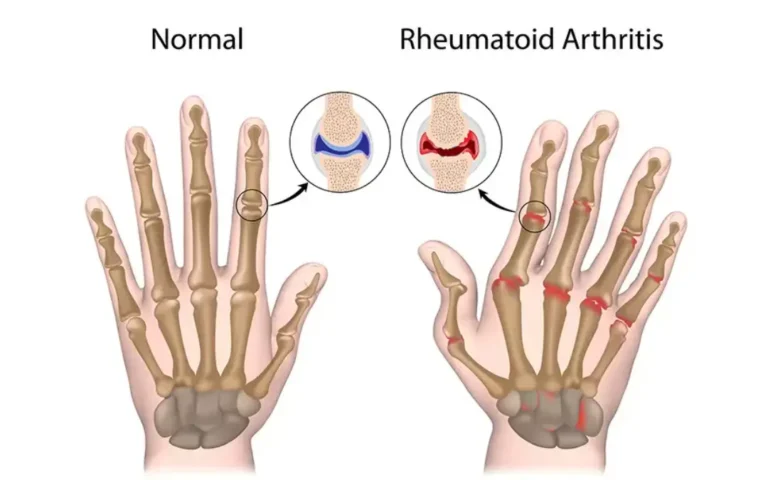 Ayurvedic treatment for Rheumatoid Arthritis 1 Ayurveda treatment for Rheumatoid arthritis