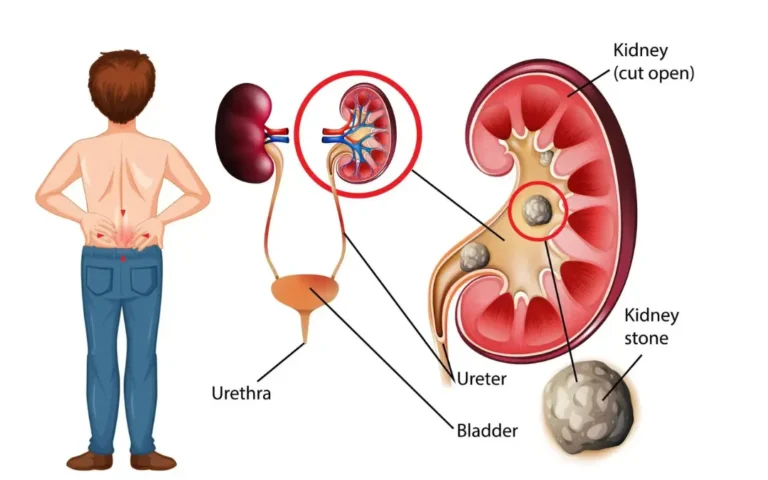 Preventing Kidney Stones from Reoccurring: Causes, Allopathic Approaches, and Ayurvedic Solutions 2 Preventing Kidney Stones from Reoccurring