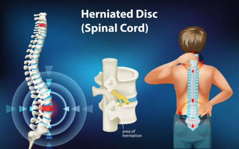 Ayurvedic doctor discussing herniated lumbar disc treatments.