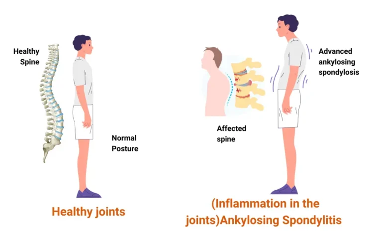 Ayurvedic treatment for Ankylosing Spondylitis