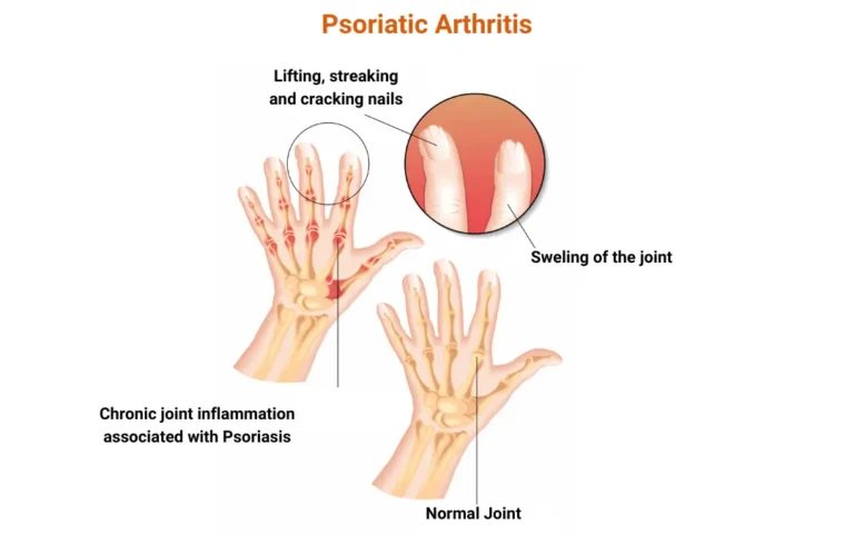 Ayurvedic treatment for psoriatic arthritis