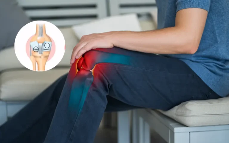 stages of Osteoarthritis