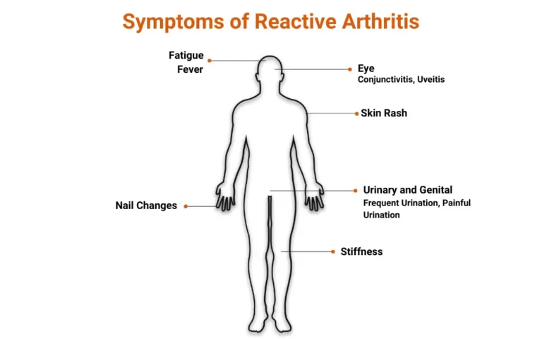 Ayurvedic treatment for Reactive Arthritis 1 Ayurvedic treatment for Reactive Arthritis