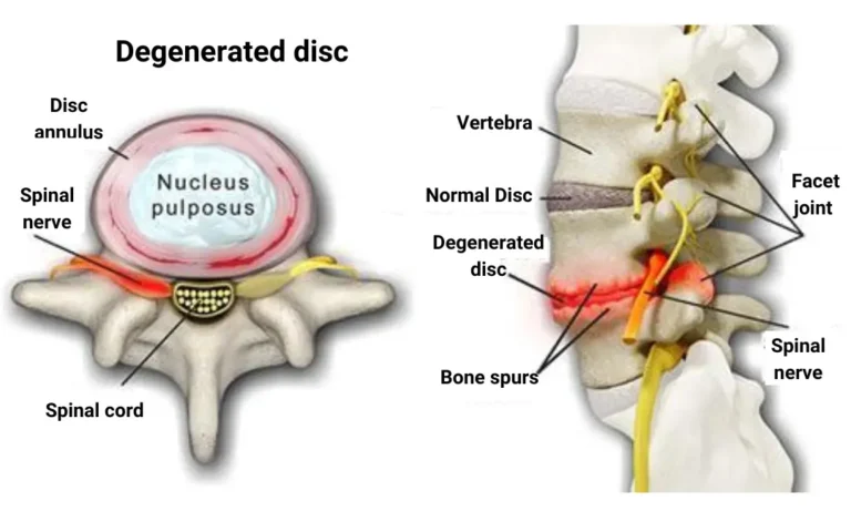 Ayurveda Treatment For Slipped Disc Symptoms And Relief