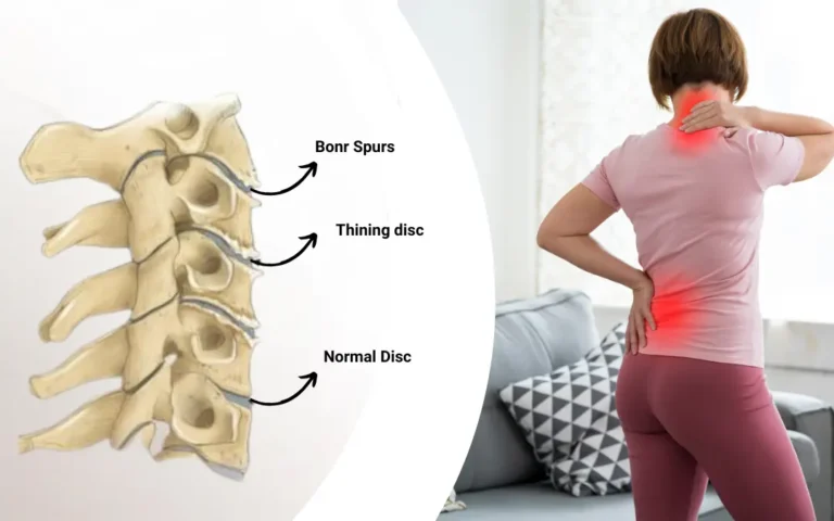 Ayurveda Treatment for Lumbosacral Spondylosis
