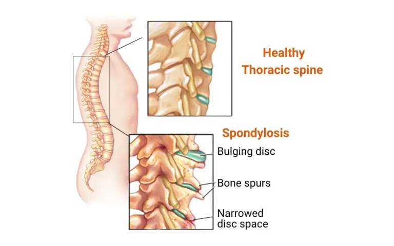 Ayurvedic Treatment for Thoracic Spondylosis